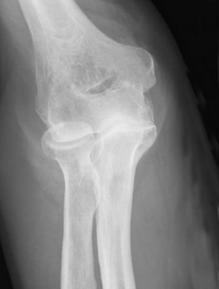 Elbow Arthroscopy | Elbow