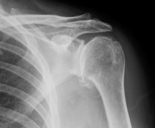 Total Shoulder Replacement | Shoulder Replacement